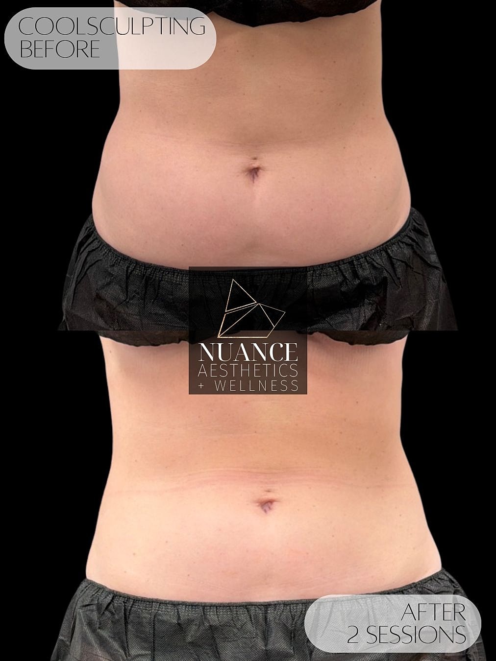 CoolSculpting® Before & After