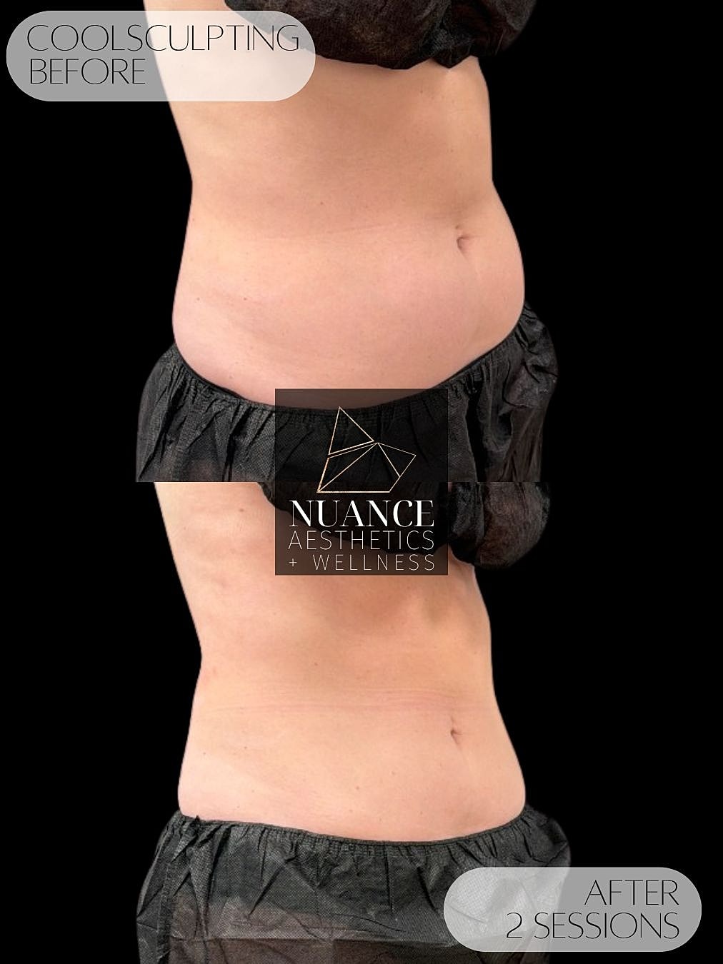 CoolSculpting® Before & After
