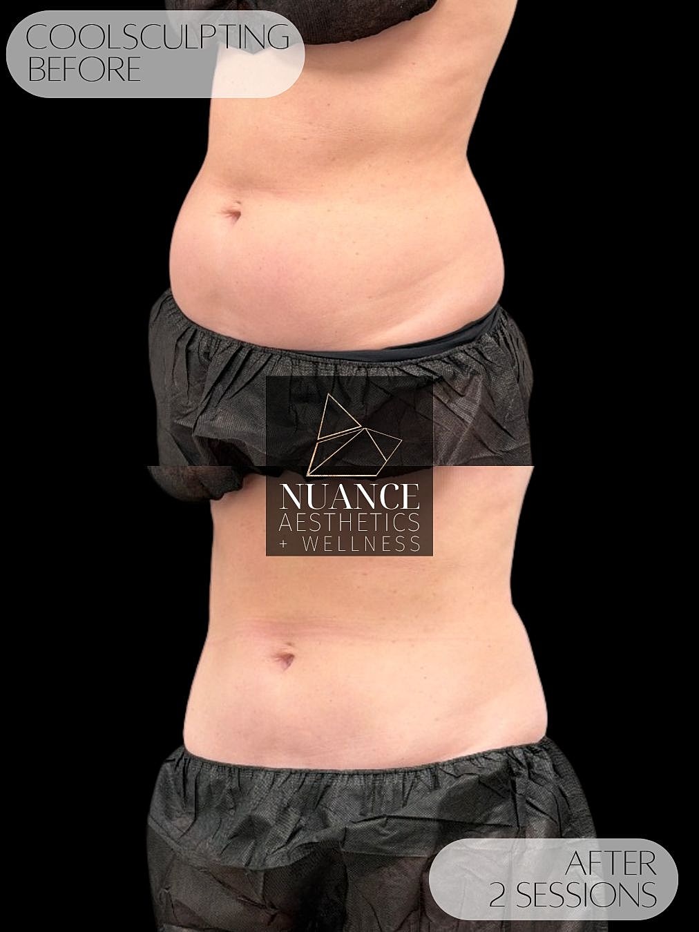 CoolSculpting® Before & After
