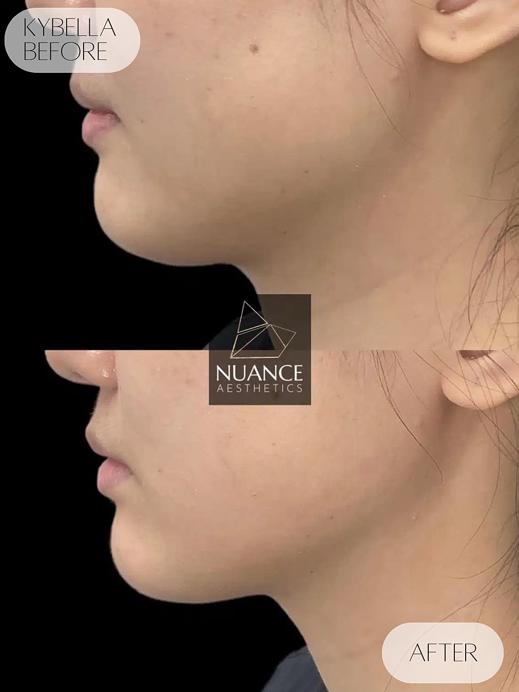 Kybella Before & After