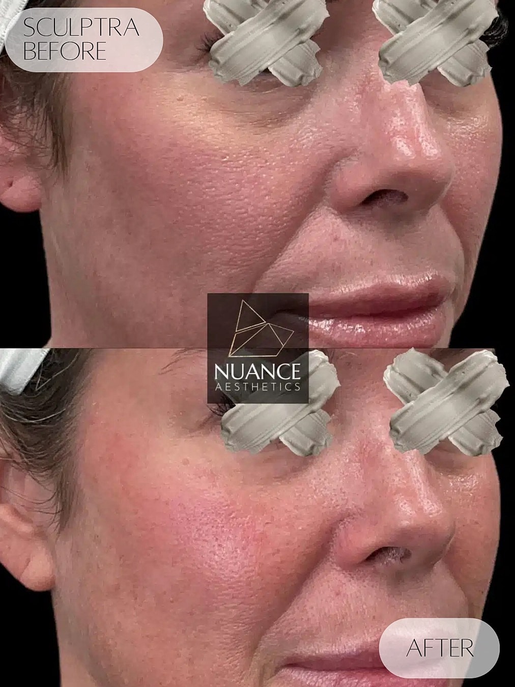 Sculptra Before & After