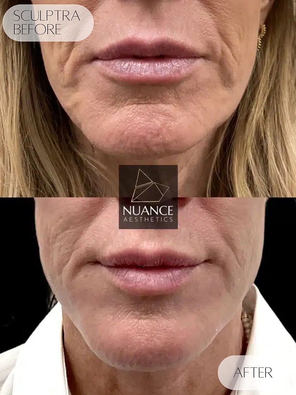 Sculptra Before & After