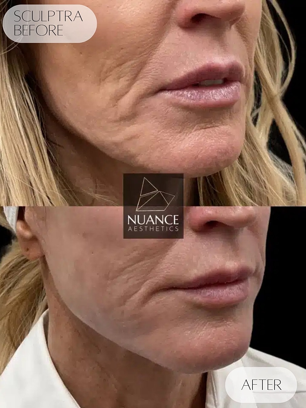 Sculptra Before & After