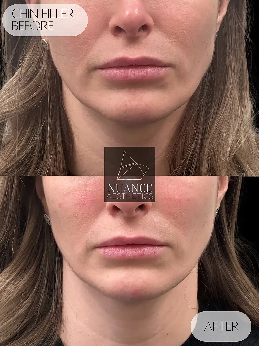 Chin Filler Before & After