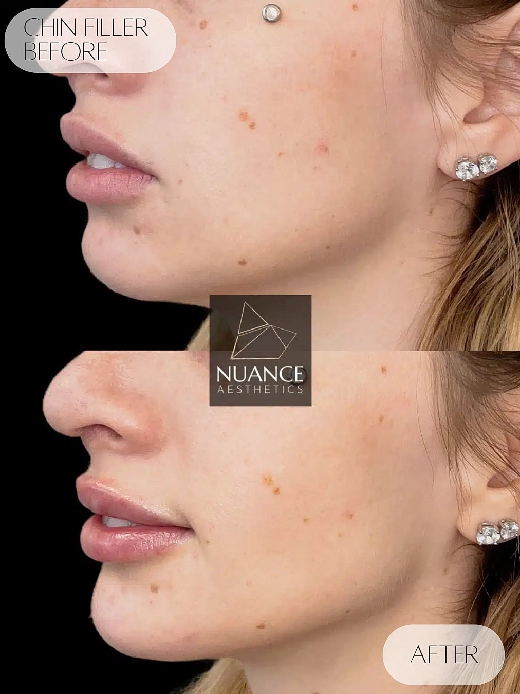 Chin Filler Before & After