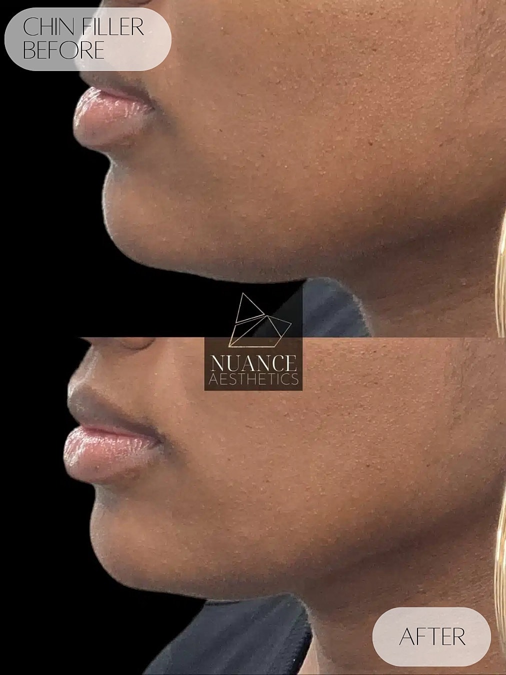 Chin Filler Before & After