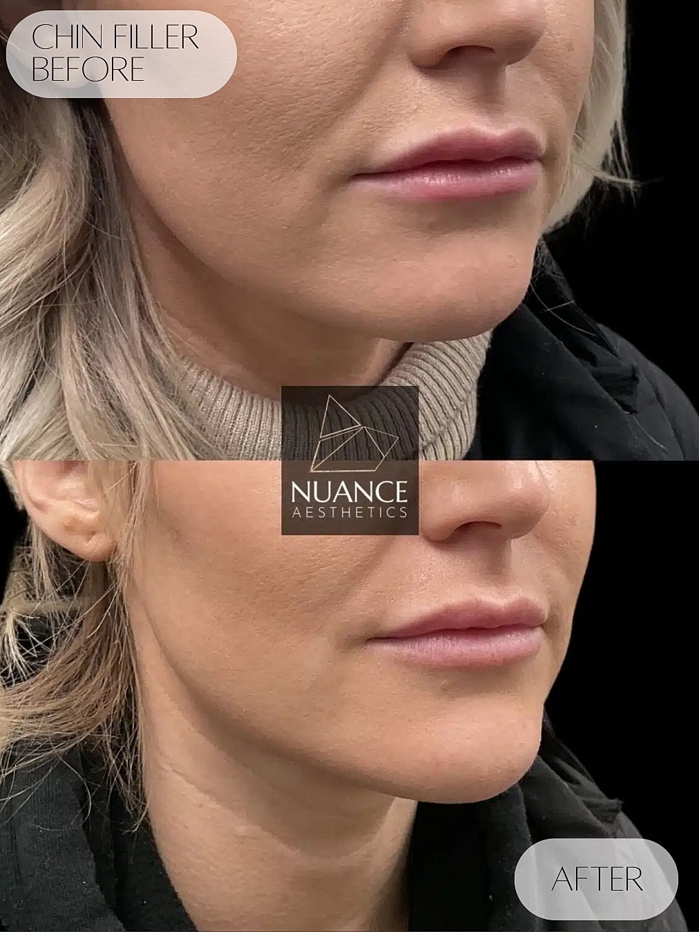 Chin Filler Before & After