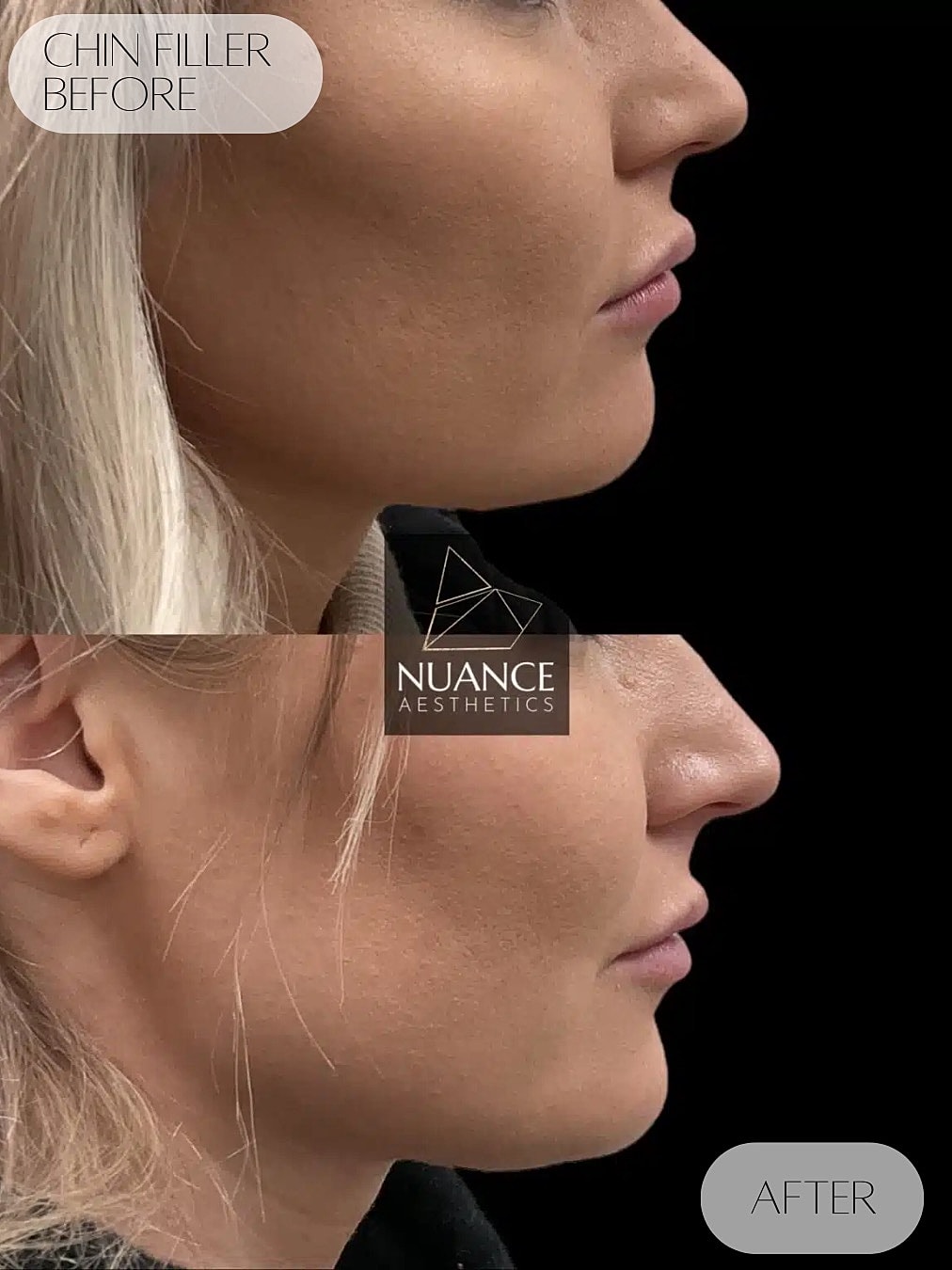 Chin Filler Before & After