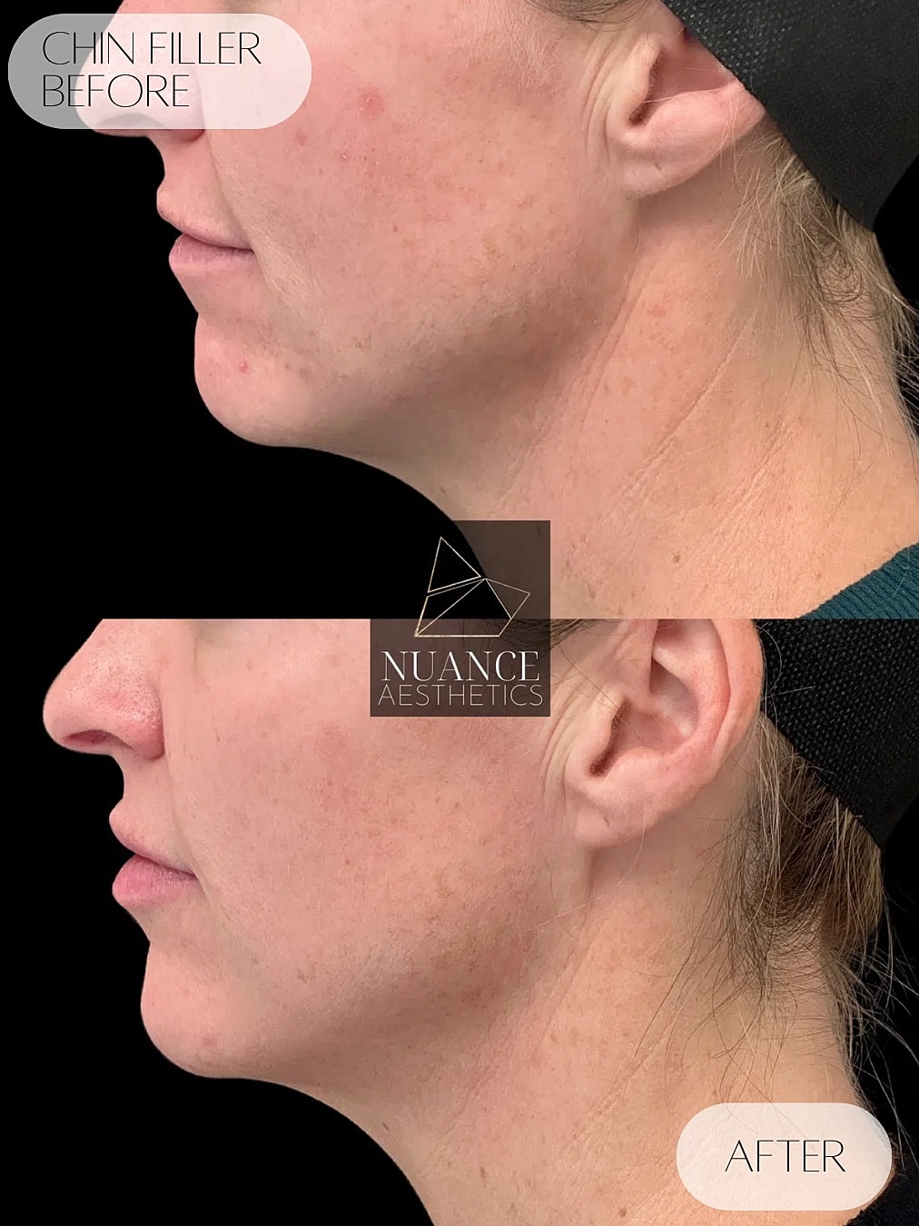 Chin Filler Before & After