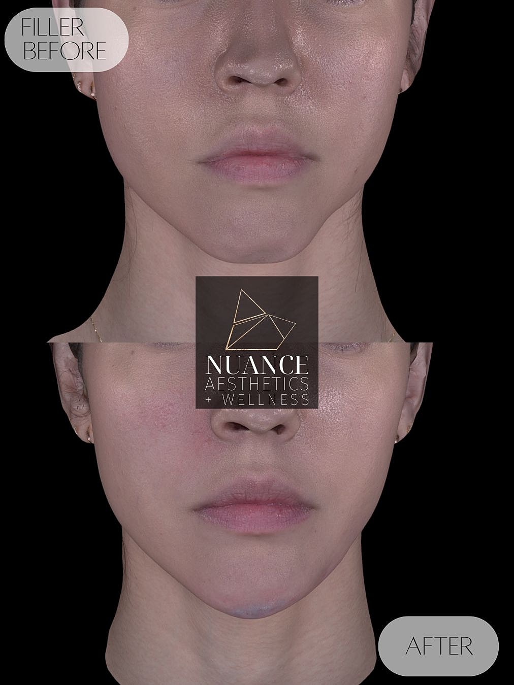Chin Filler Before & After