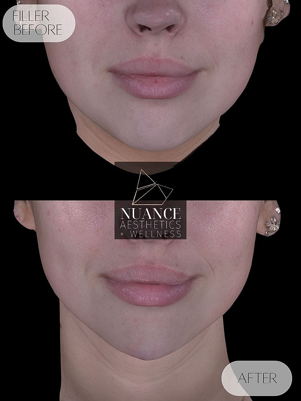 Chin Filler Before & After