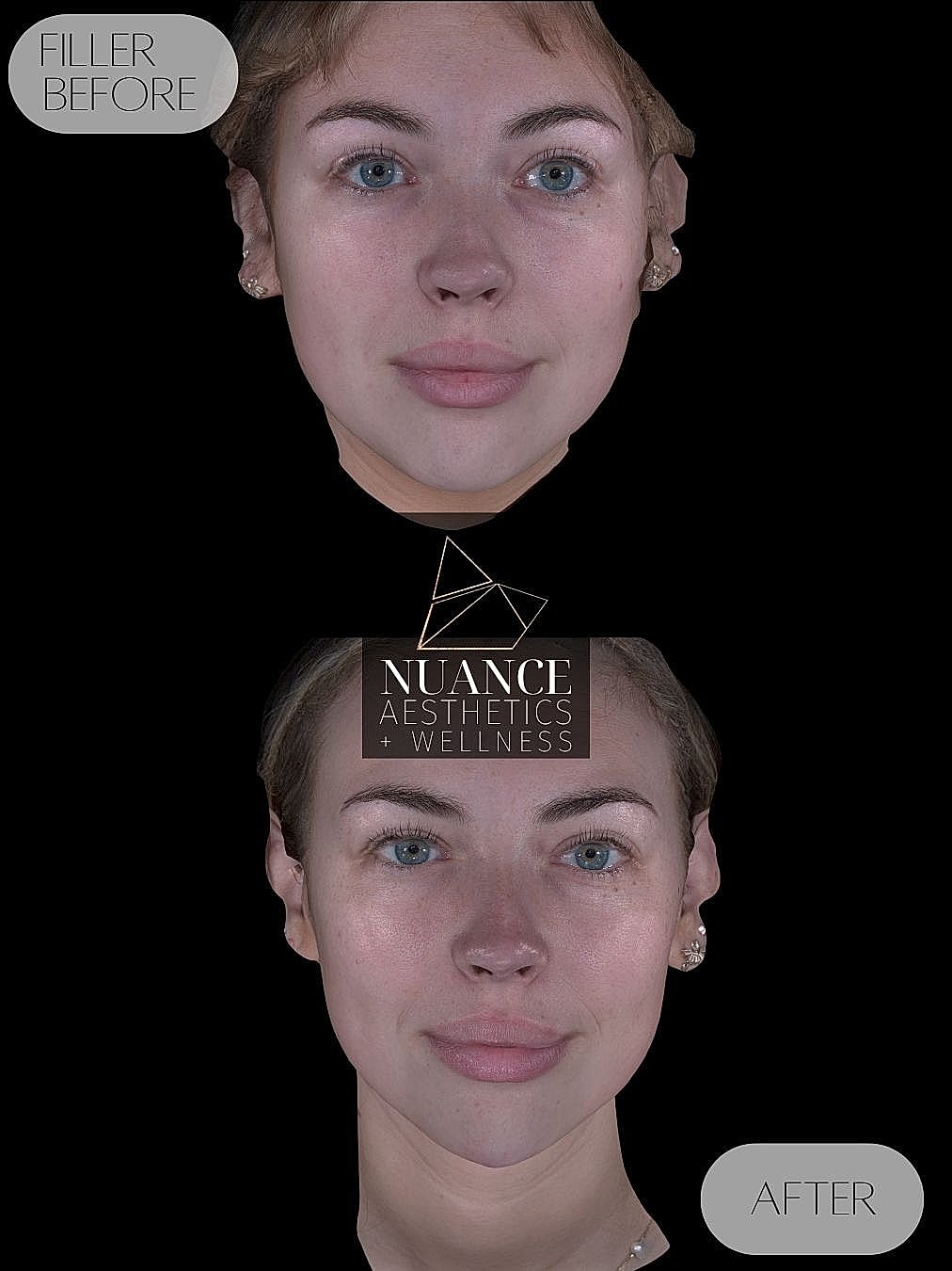 Chin Filler Before & After