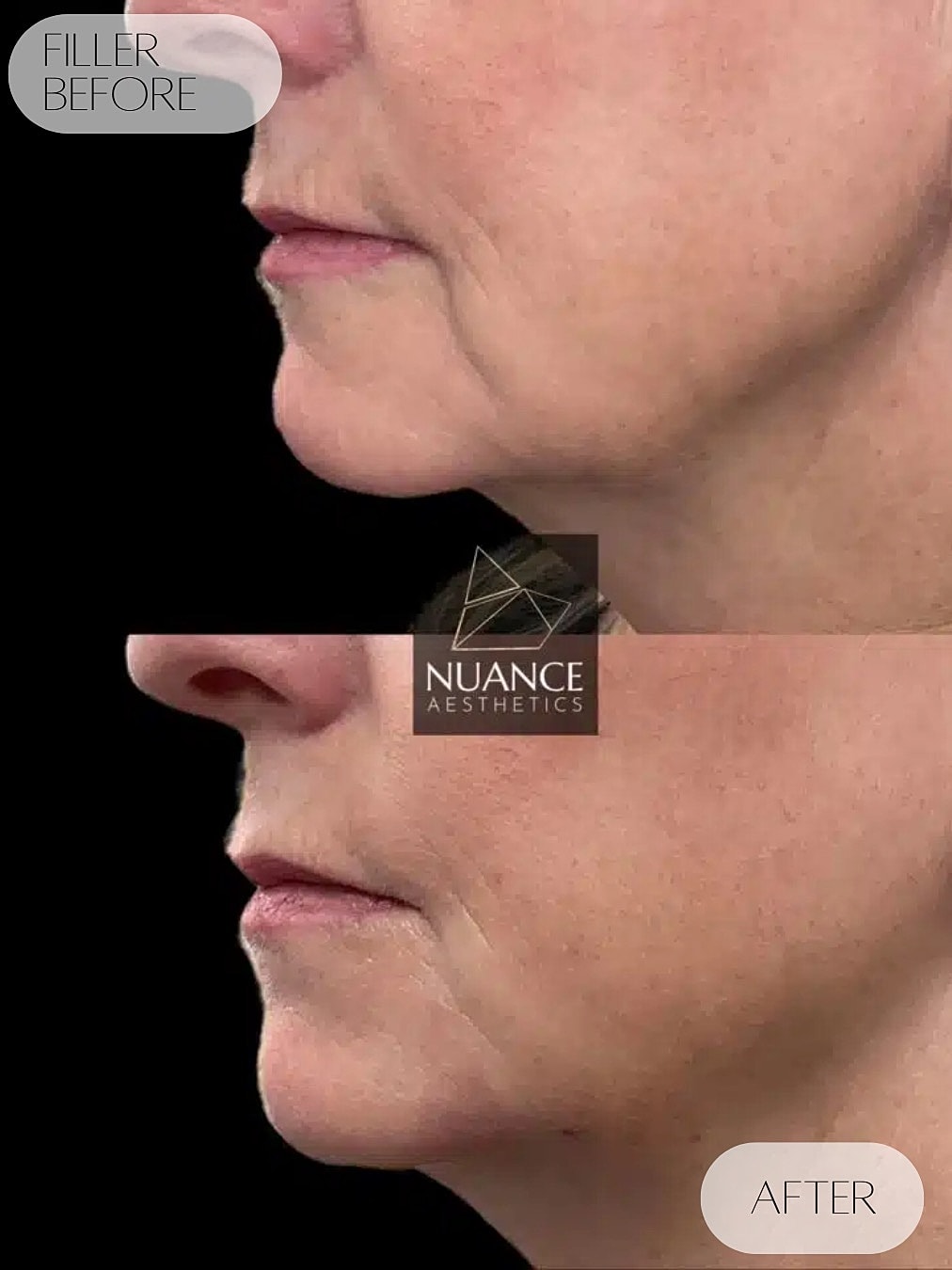 Dermal Fillers Before & After