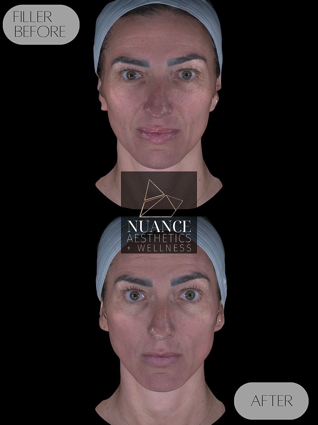 Dermal Fillers Before & After