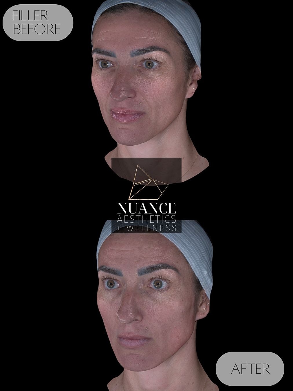 Dermal Fillers Before & After
