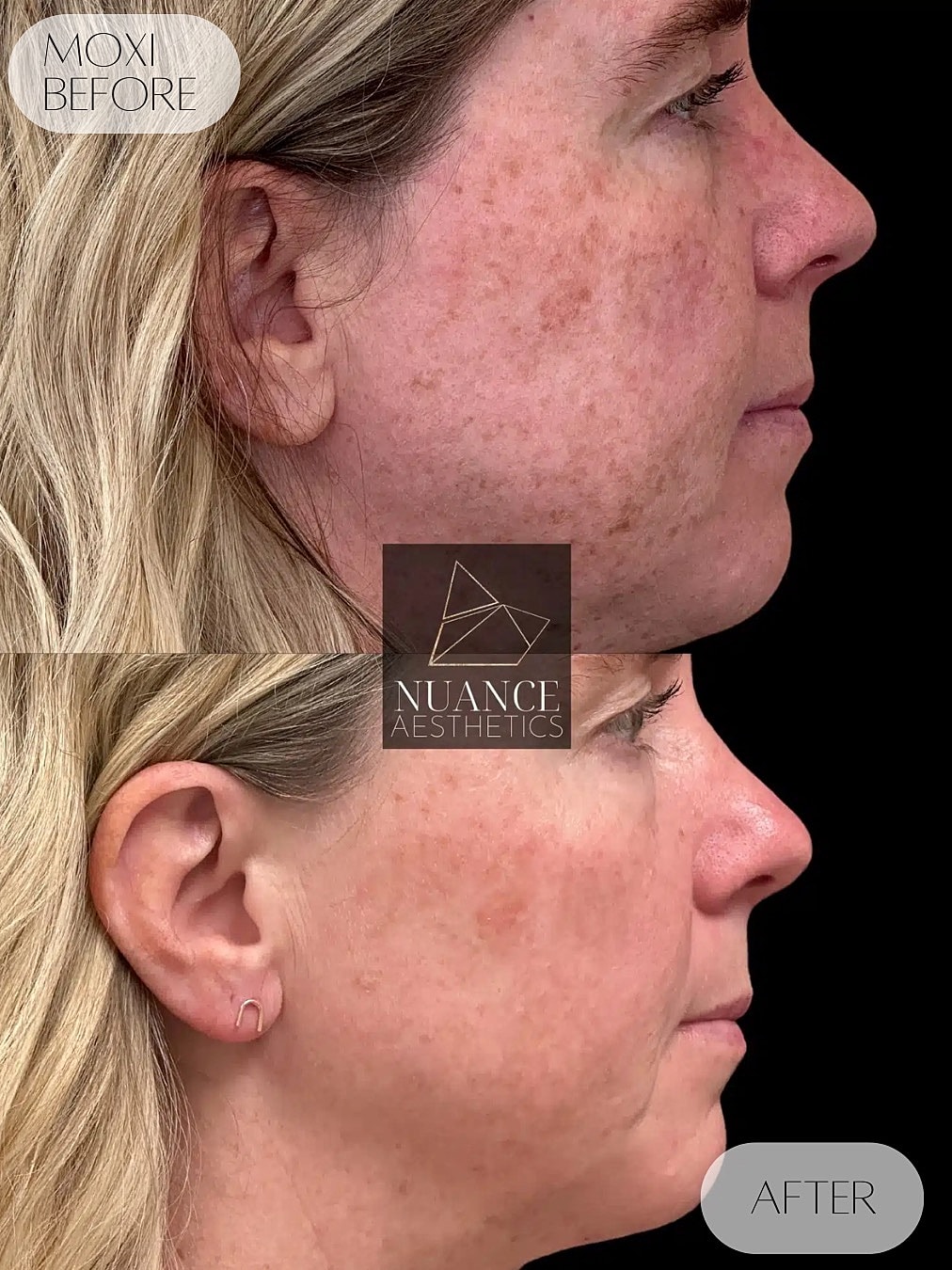 Moxi Laser Before & After