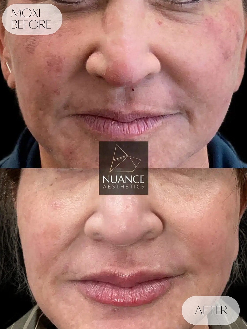 Moxi Laser Before & After
