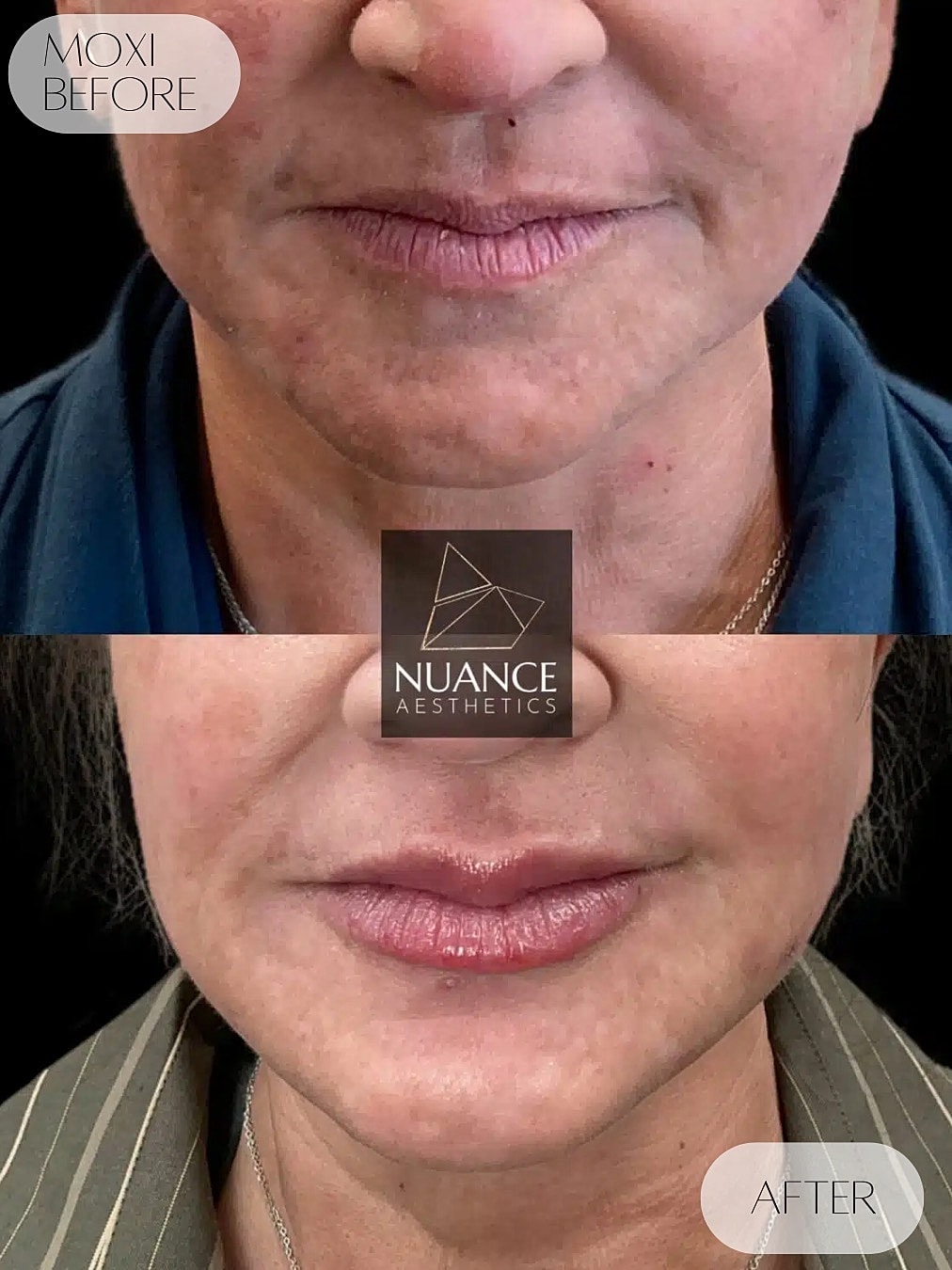 Moxi Laser Before & After
