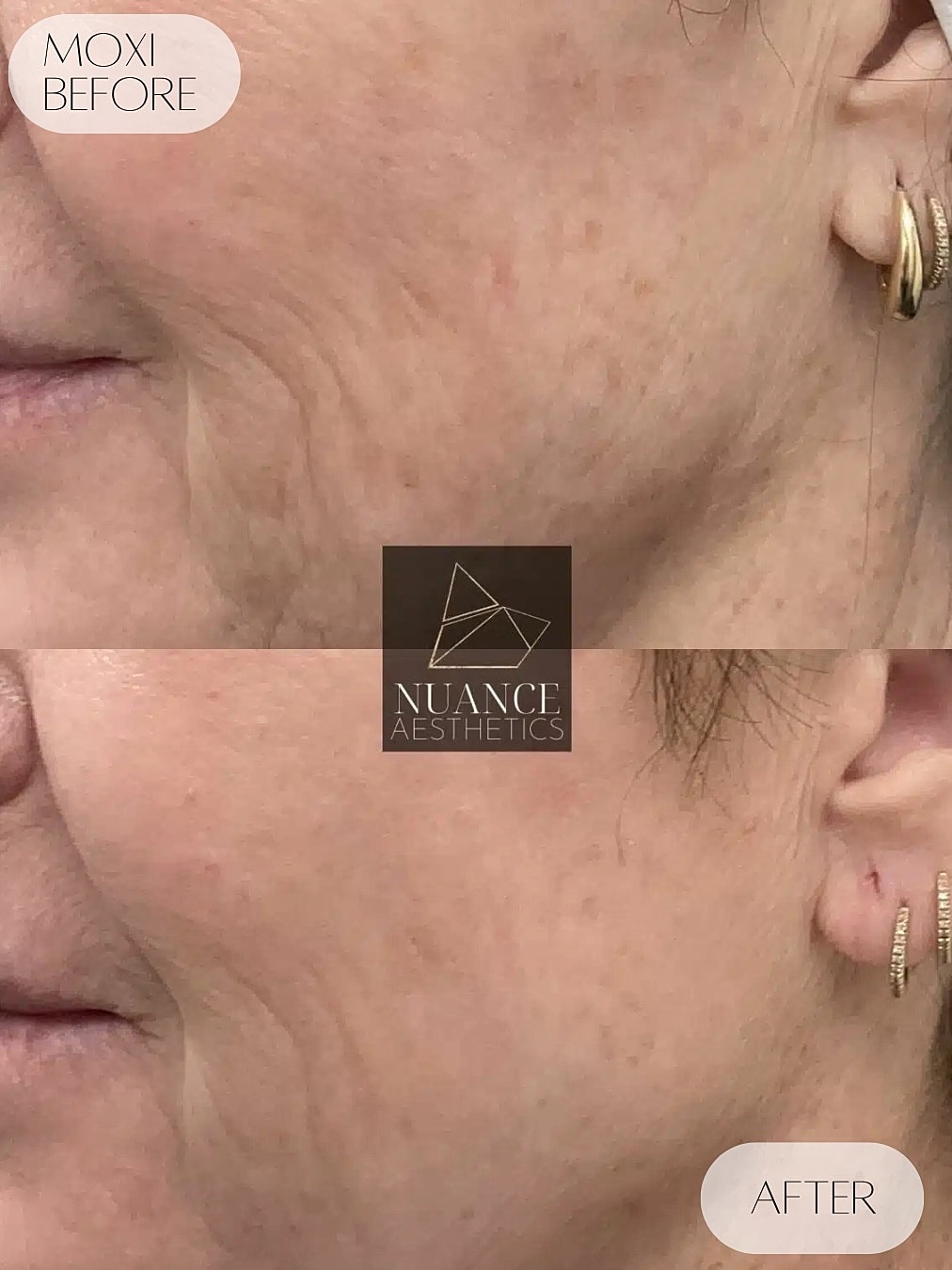 Moxi Laser Before & After