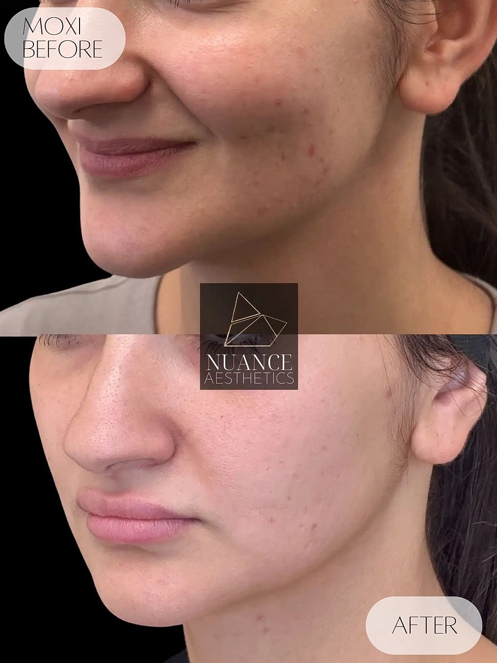 Moxi Laser Before & After