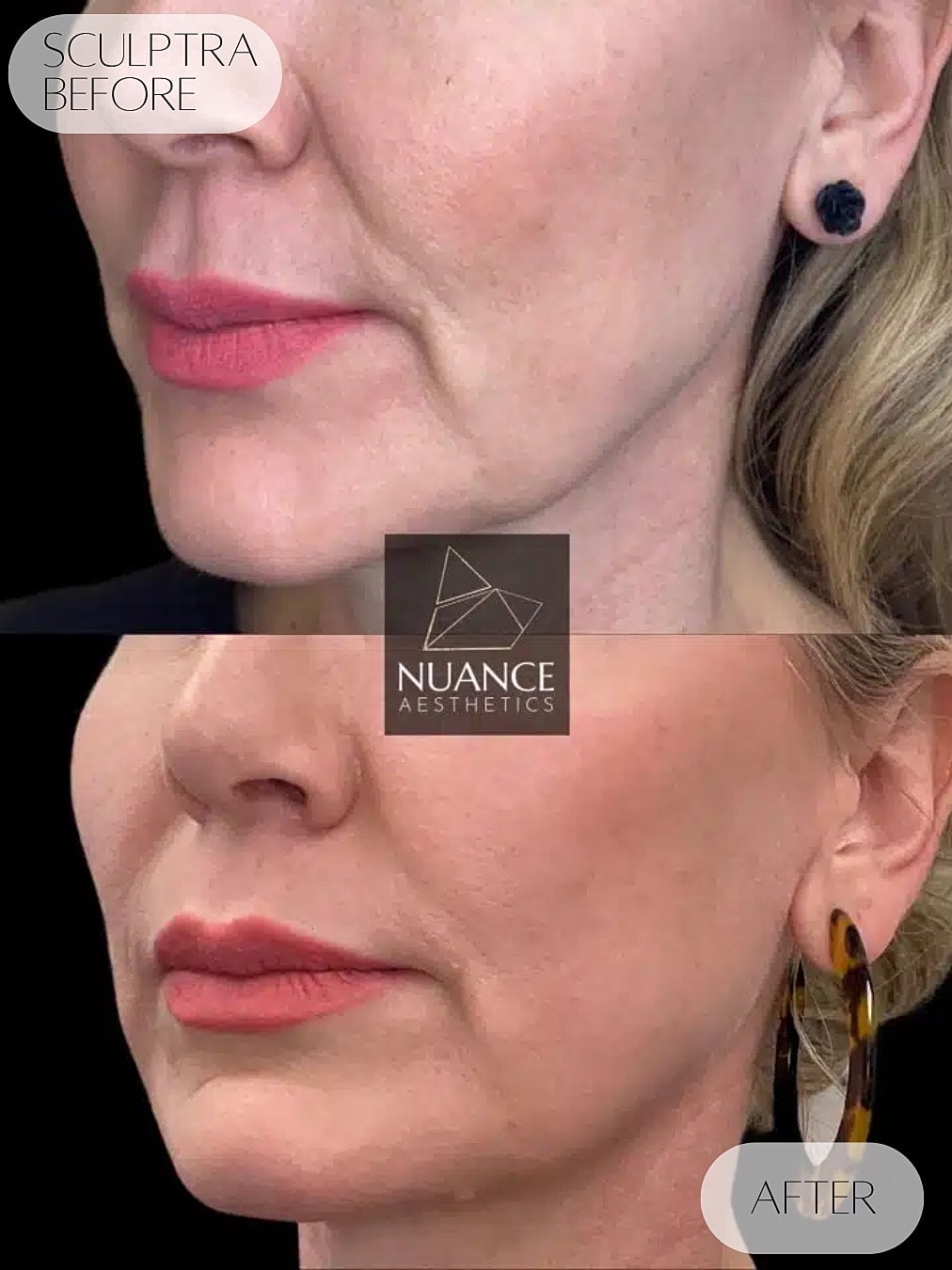 Jawline Injections Before & After