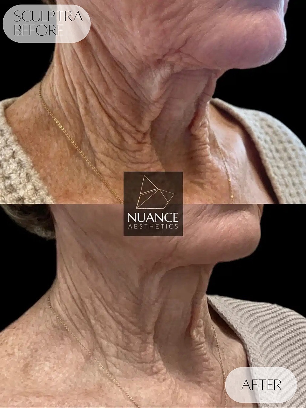 Jawline Injections Before & After
