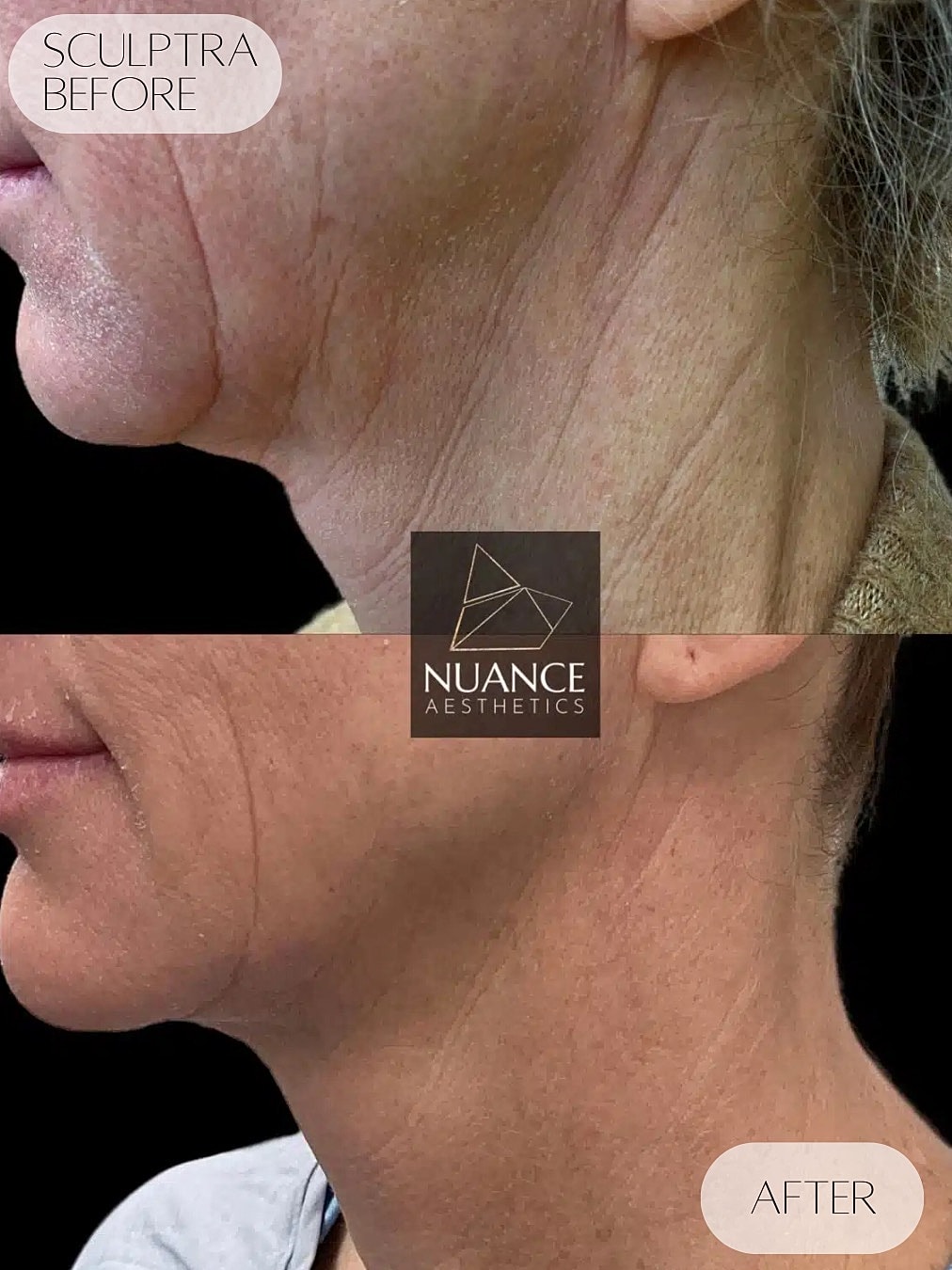 Jawline Injections Before & After